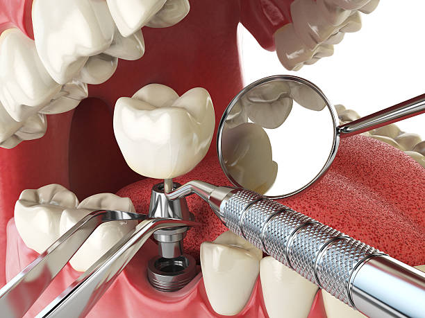 Best Emergency Dental Care for Broken or Chipped Teeth in Toro Nyon, CA